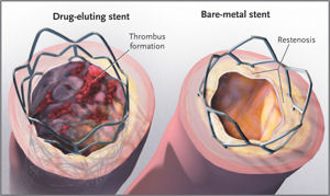 Ingrowth of tissue may cause bare-metal stents to become obstructed resulting in the need for a second procedure Drug-eluting stents inhibit this process but uncovered struts may be prone to thromb
